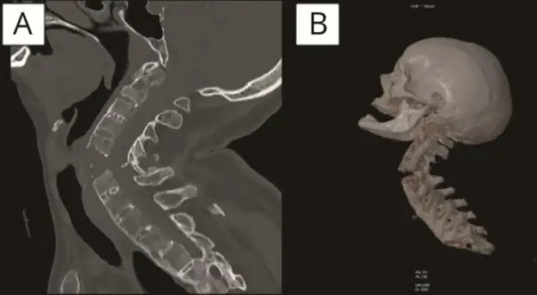 Corte sagital y reconstrucción 3D de columna cervical mostrando una grave fractura cervical.