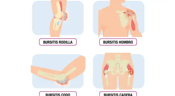 Ilustraciones de bursitis en rodilla, hombro, codo y cadera, mostrando inflamación en las articulaciones.