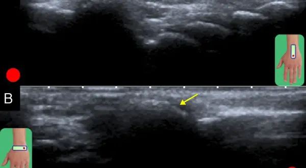 Ecografía muestra un carpal boss, una protuberancia ósea en la muñeca, con flechas señalando la zona afectada.
