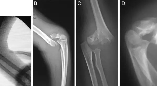 Radiografías de codo muestran una fractura supracondilea con desplazamiento y fragmentación ósea, indicando una lesión compleja.