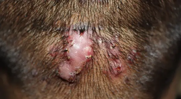 Un bulto en la nuca con varias lesiones rosadas y costras, rodeado de cabello oscuro.