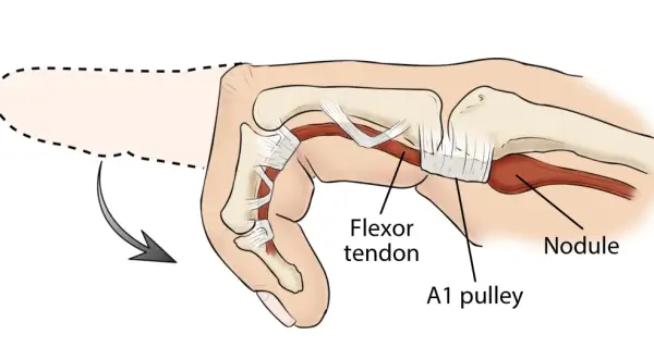 Anatomía del dedo en gatillo: un tendón flexor engrosado y un nódulo impiden el movimiento suave a través de la polea A1.