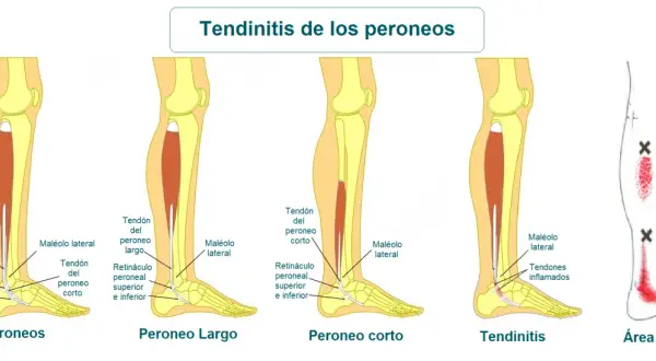 Ilustración de la anatomía del tobillo y la pierna, mostrando el tendón peroneo lateral largo y la tendinitis.