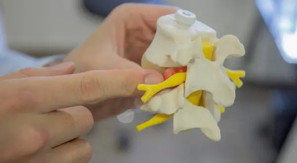 Modelo de vértebras y nervios, mostrando la distribución de los dermatomas cervicales.