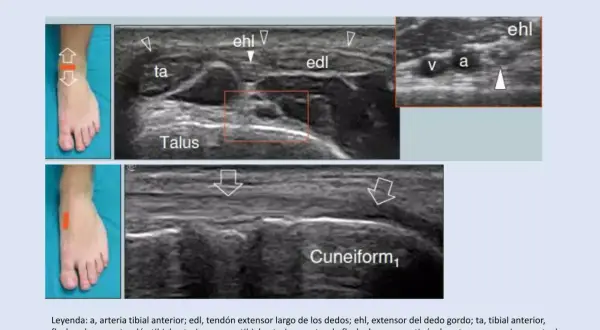 Ecografía del tobillo: muestra tendones extensores, arteria y vena tibial anterior, y el nervio peroneo profundo.