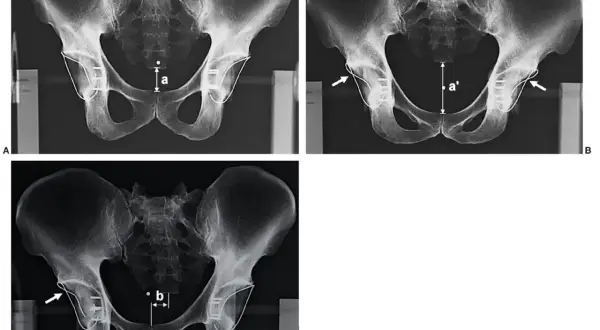 Radiografía de cadera que muestra mediciones y fijaciones. La imagen A compara la distancia 'a'. La imagen B muestra la distancia 'a'' y la flecha indica un implante. La imagen C muestra la distancia 'b' y una flecha señala un implante.