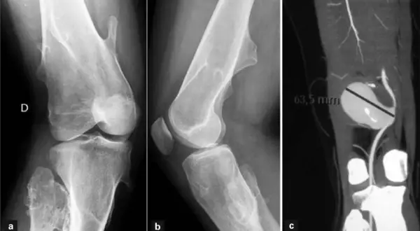 Radiografías y TC de rodilla que muestran un osteocondroma. La imagen c revela un aneurisma de 63,5 mm.