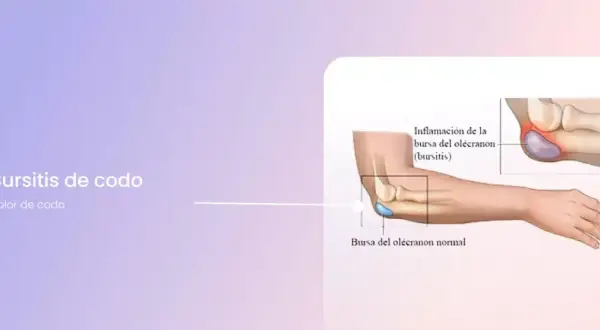 Ilustración de la bursitis de codo, mostrando la inflamación de la bursa del olécranon.