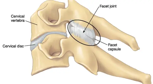 Ilustración de vértebras cervicales y disco, destacando la articulación facetaria y su cápsula, relevante para entender la sinovitis facetaria.