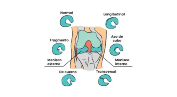 Ilustración de rodilla con diferentes tipos de lesiones meniscales, incluyendo el cuerno posterior del menisco interno.