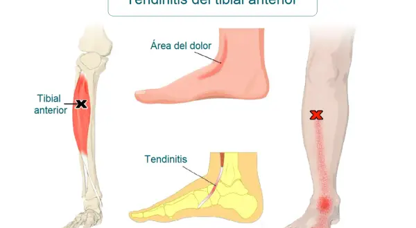 Ilustración médica que muestra la tendinitis tibial anterior, con el músculo tibial anterior marcado y áreas de dolor en el pie y la espinilla.