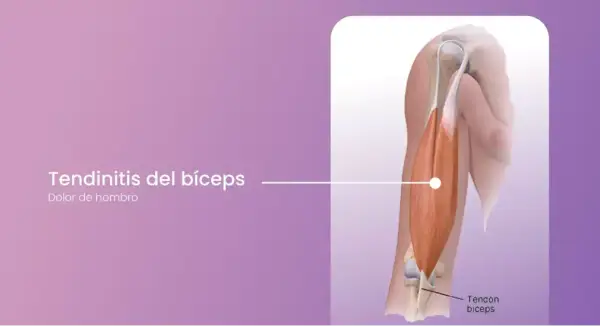 Ilustración de la tendinitis del bíceps, mostrando el tendón del bíceps y el dolor de hombro asociado.