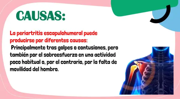 Causas de la periartritis escapulohumeral: golpes, contusiones, sobreesfuerzo o falta de movilidad del hombro. Ilustración de un hombro con dolor.