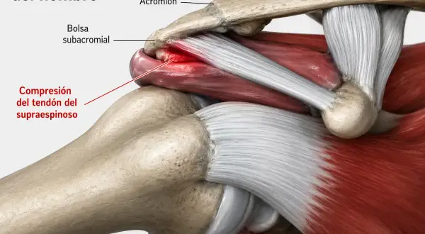 Ilustración anatómica del **impingement subacromial** en el hombro, mostrando la compresión del tendón del supraespinoso.