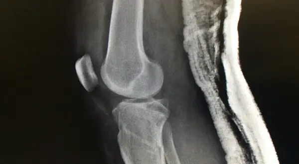 Radiografía de rodilla con fractura de meseta tibial, indicando el grado de discapacidad.