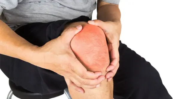 Hombre con dolor en la rodilla, con la rótula enrojecida. A pesar del dolor, se puede andar con la rótula rota.