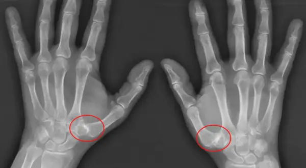 Radiografías de ambas manos mostrando rizartrosis grados avanzados en la base del pulgar, con deformidad ósea y estrechamiento articular.