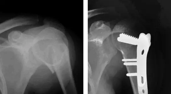 Radiografía muestra fractura humero proximal antes y después de la cirugía con placa y tornillos.