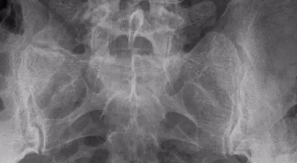 Radiografía de pelvis y columna lumbar. Se observan cambios degenerativos y esclerosis en la apófisis transversa.