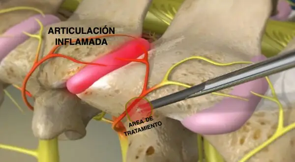 Ilustración de articulación interapofisaria inflamada y su tratamiento.