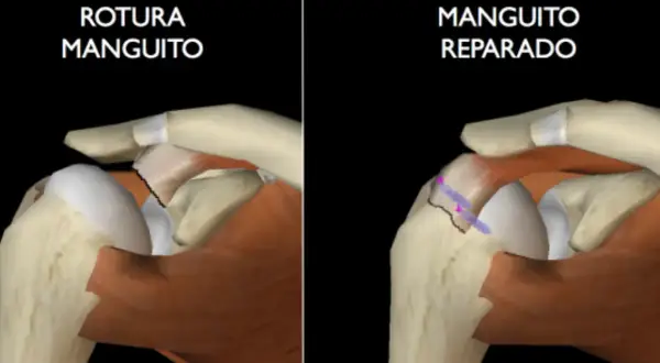 Comparación de un manguito rotador roto con uno reparado, mostrando cómo el manguito rotador se cura solo.