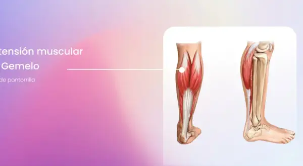 Ilustración anatómica de la pantorrilla, mostrando la distensión muscular del gemelo y el dolor asociado en la pierna.