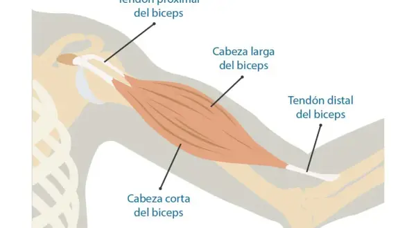 Anatomía del bíceps, mostrando tendón proximal, cabeza larga y corta, y tendón distal. Ilustra la zona donde puede ocurrir una rotura de bíceps.