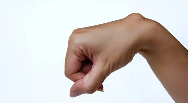 Mano con un bulto visible en la muñeca, indicativo de un ganglio muñeca operacion.