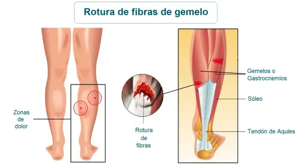 Ilustración de las secuelas de rotura fibrilar gemelo, mostrando zonas de dolor y detalle de la rotura.