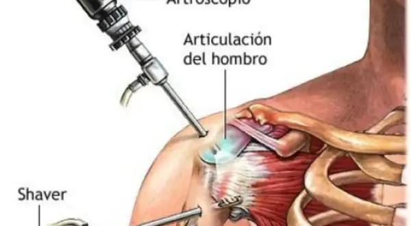 Ilustración de artroscopia de hombro para tratar una luxación glenohumeral. Se ven un artroscopio y un shaver.