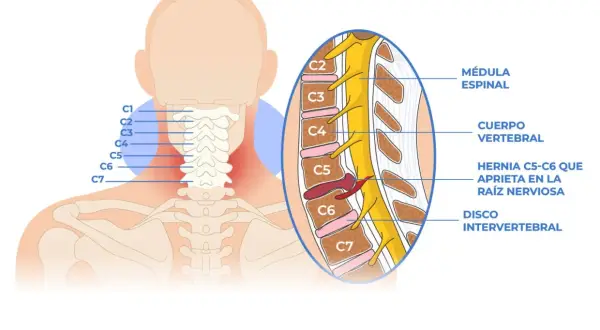 Ilustración de la columna cervical mostrando un pinzamiento cervical C5-C6 que comprime una raíz nerviosa.