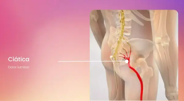 Ilustración de ciática, mostrando dolor lumbar derecho irradiado hacia adelante a lo largo del nervio ciático.