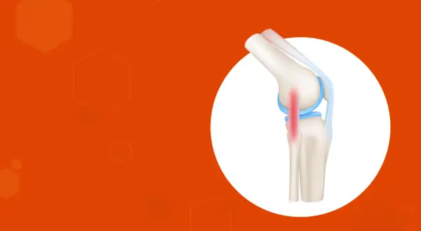 Ilustración de rodilla con tendinitis en el ligamento lateral externo, marcada en rojo.