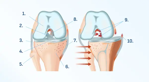 Ilustración de rodilla sana y lesionada. La imagen de la derecha muestra una rotura de ligamentos, causando dolor al apoyar la rodilla en el suelo.
