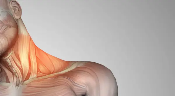 Anatomía del cuello con los escalenos musculos resaltados en rojo, indicando posible tensión o dolor.