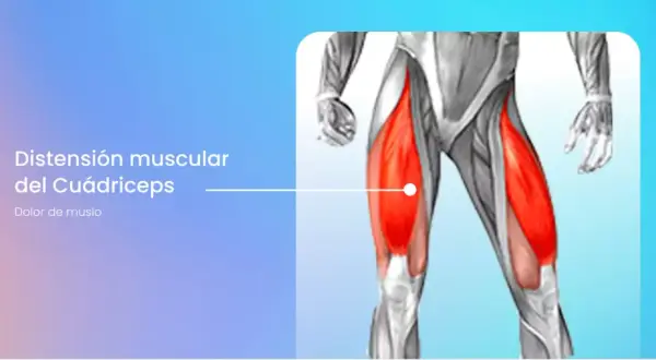 Anatomía del cuádriceps con el vasto interno inflamado, indicando dolor de muslo.