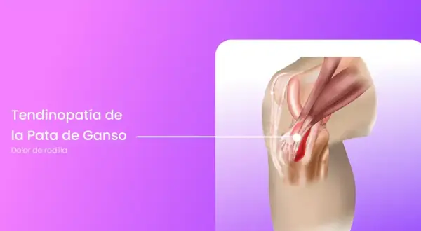 Ilustración de la tendinopatía de la pata de ganso en la rodilla, mostrando la inflamación y el dolor. La recuperación es clave.