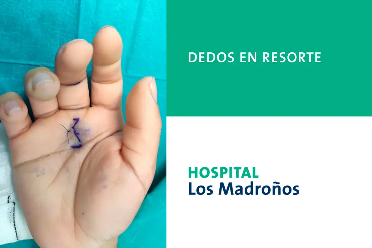 Mano con marca para cirugía de dedo en resorte. Ecografía muestra la mano de un paciente con marcas quirúrgicas en la palma y los dedos, indicando el tratamiento para el dedo en resorte.
