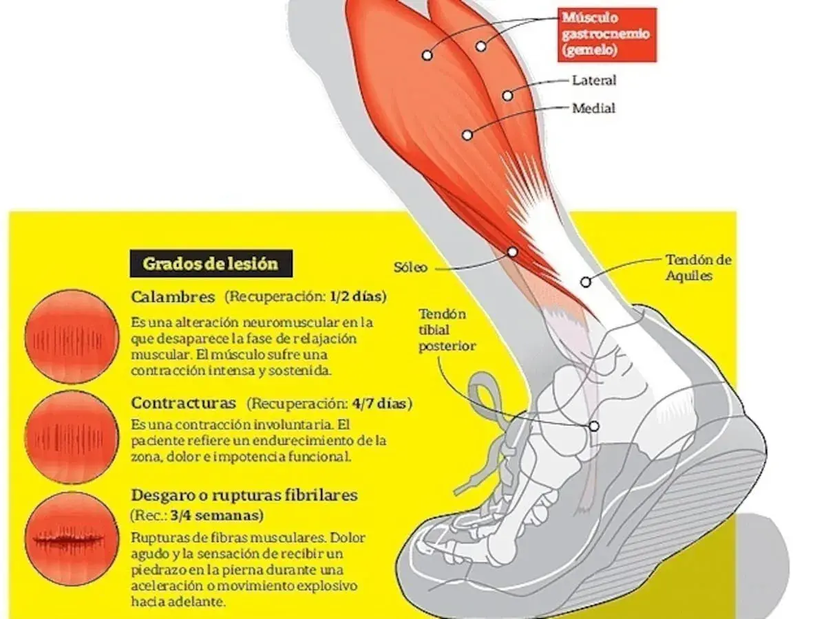 Ilustración de la anatomía de la pierna, detallando el músculo sóleo y los grados de lesión muscular, como desgarros.