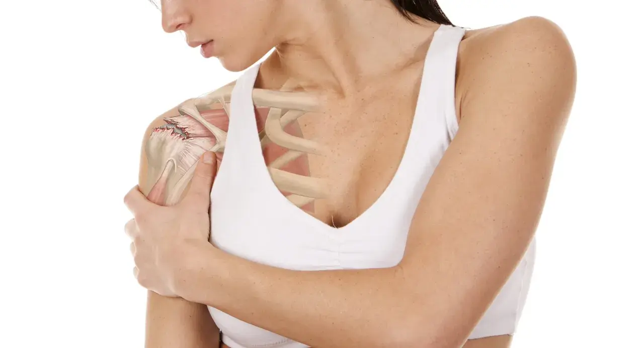 Anatomía del hombro con detalle de desgarro en el manguito rotador, mostrando el dolor y la inflamación.