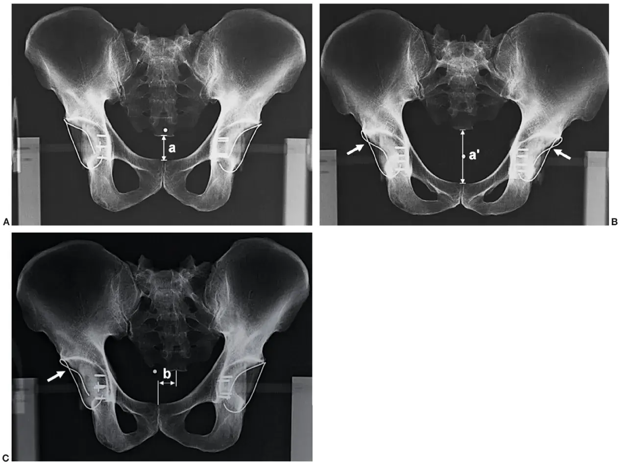 Radiografía de cadera que muestra mediciones y fijaciones. La imagen A compara la distancia 'a'. La imagen B muestra la distancia 'a'' y la flecha indica un implante. La imagen C muestra la distancia 'b' y una flecha señala un implante.