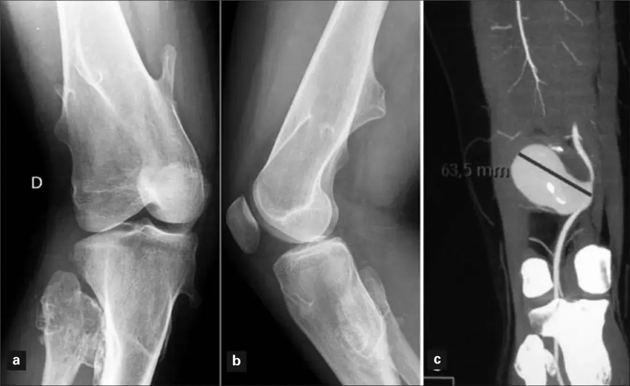 Radiografías y TC de rodilla que muestran un osteocondroma. La imagen c revela un aneurisma de 63,5 mm.