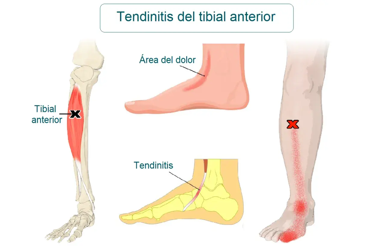 Ilustración médica que muestra la tendinitis tibial anterior, con el músculo tibial anterior marcado y áreas de dolor en el pie y la espinilla.
