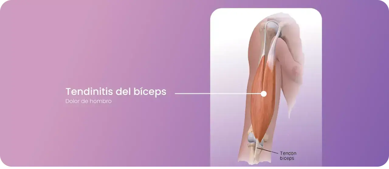 Ilustración de la tendinitis del bíceps, mostrando el tendón del bíceps y el dolor de hombro asociado.