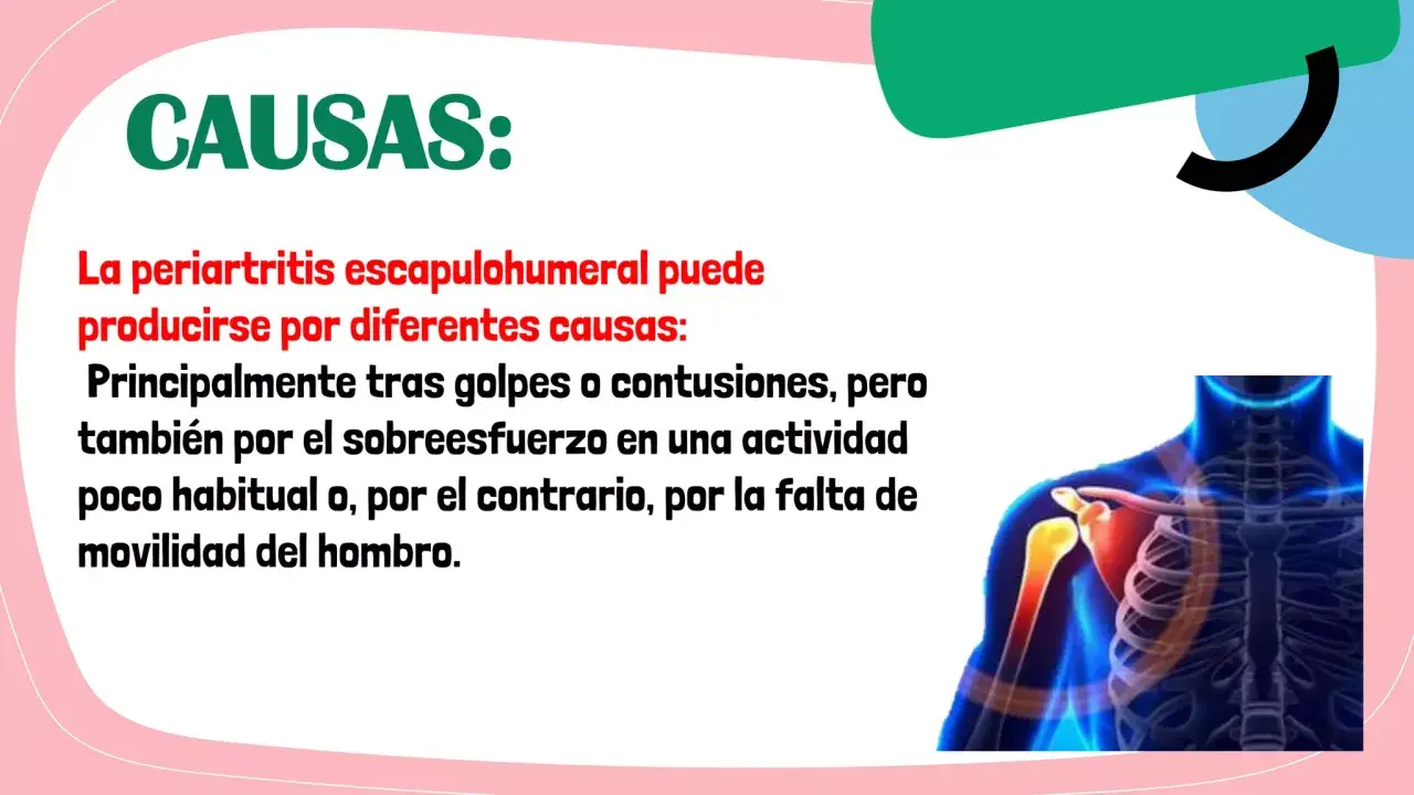 Causas de la periartritis escapulohumeral: golpes, contusiones, sobreesfuerzo o falta de movilidad del hombro. Ilustración de un hombro con dolor.