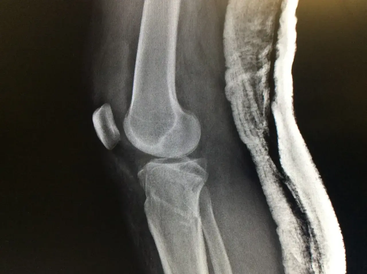 Radiografía de rodilla con fractura de meseta tibial, indicando el grado de discapacidad.
