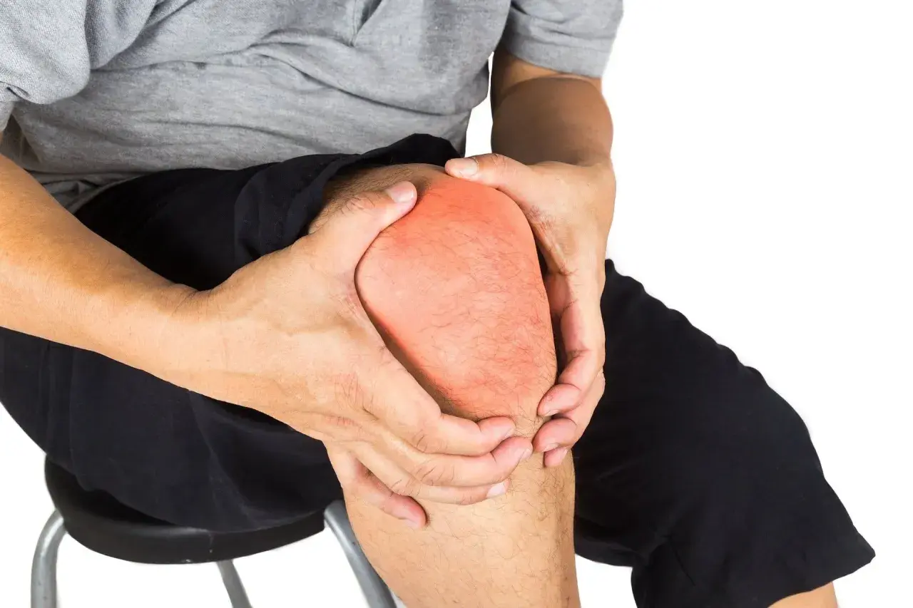 Hombre con dolor en la rodilla, con la rótula enrojecida. A pesar del dolor, se puede andar con la rótula rota.