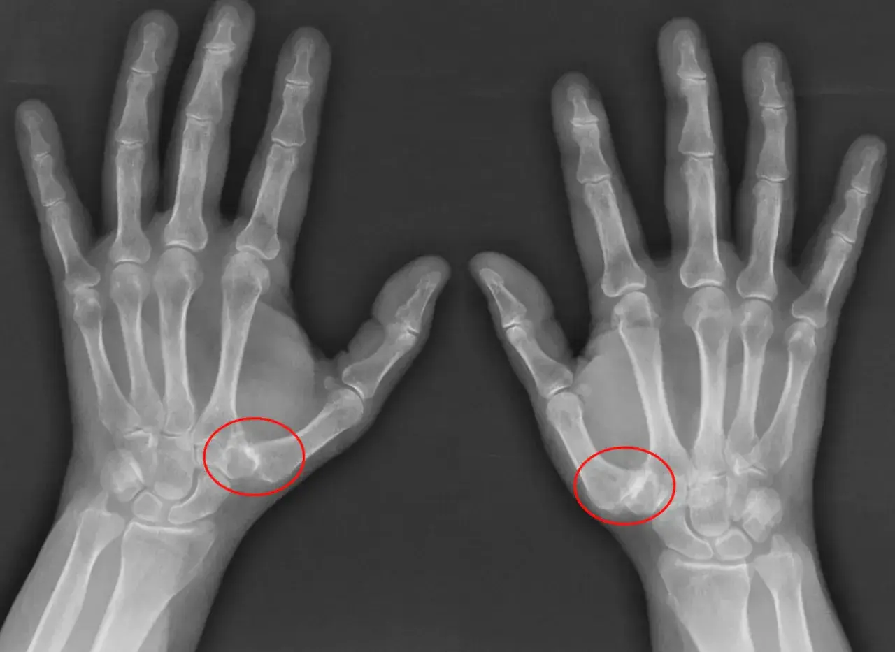 Radiografías de ambas manos mostrando rizartrosis grados avanzados en la base del pulgar, con deformidad ósea y estrechamiento articular.