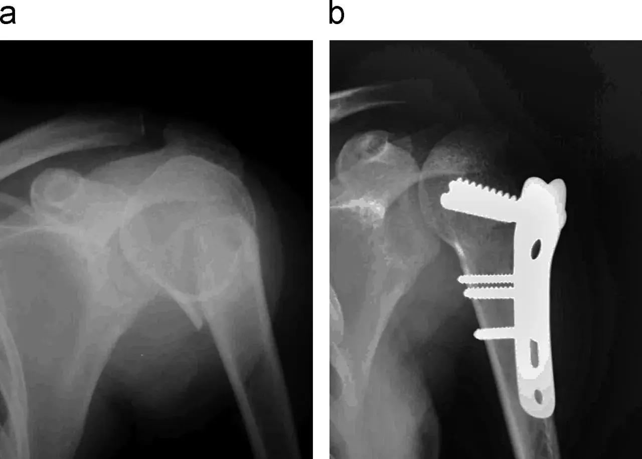 Radiografía muestra fractura humero proximal antes y después de la cirugía con placa y tornillos.