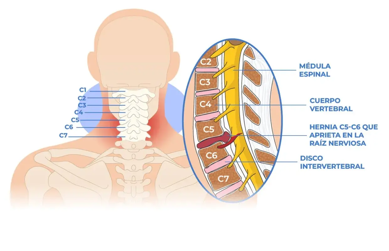 Ilustración de la columna cervical mostrando un pinzamiento cervical C5-C6 que comprime una raíz nerviosa.